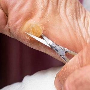 Callus Removal & Foot Care